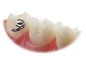 Preview: VIPER™, Bondable buccal tube, Mini (tooth 27, 47) .018" Standard: Torque 0°, Offset 0°