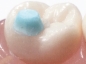 Preview: MiniMold System - Posterior Molar Pad Tips
