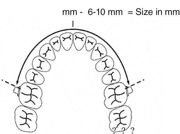 Molar Distalizing Arch, Size 3 (86 mm)