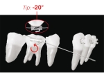 XBT - Bondable Buccal Tubes for uprighting / anchorage of 1st molar (tooth 46, 36)
